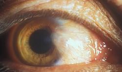 Report: Driving can contribute to deadliest cancer, particularly on your left side-pterygium.jpg